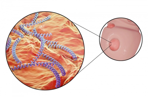 Xoắn khuẩn giang mai là tác nhân chính gây bệnh